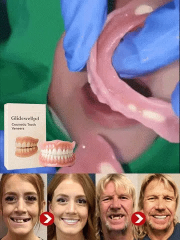 Premium Full Cover Dentures